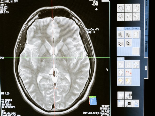 Nanoparticle triggers the immune system, outsmarting brain cancer