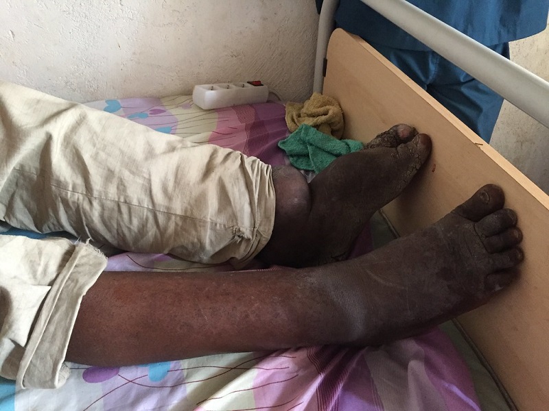 Campaign started to vaccinate people against elephantiasis