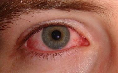 Enterovirus infection prevalent in viral conjunctivitis