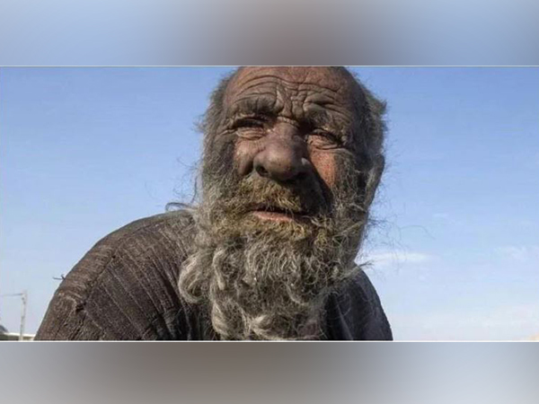 ‘World’s dirtiest man’ dies shortly after taking first bath in decades