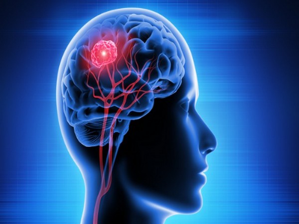 Brain waves predict cognitive impairment in Parkinson’s