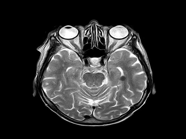 Blood tests in newly brain-injured patients predict death