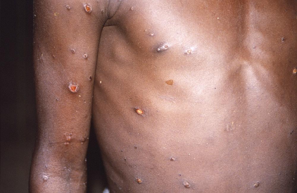 Canada confirms 803 monkeypox cases