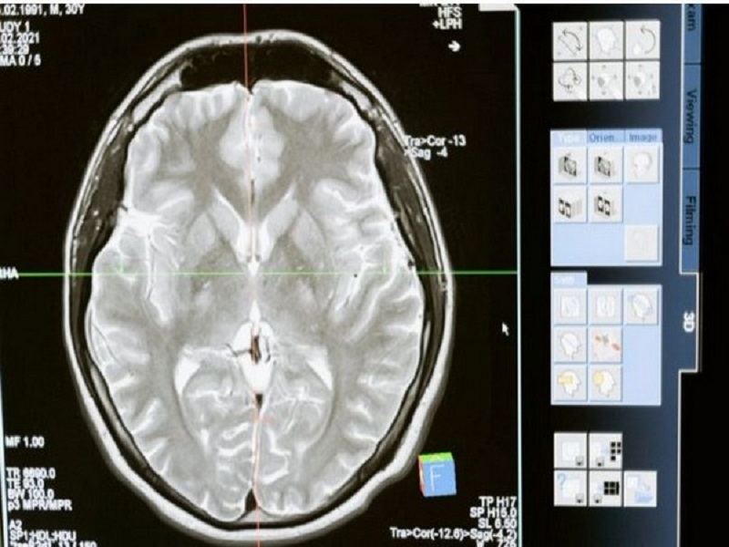 Varying immune cell levels in canine brain tumours could provide therapeutic targets: Study