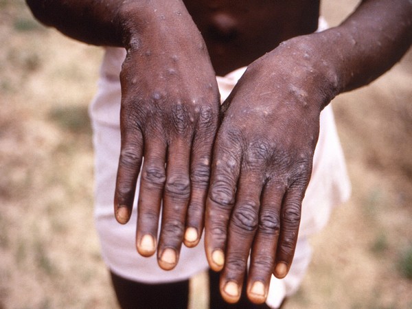 Monkeypox cases in Britain surpass 500