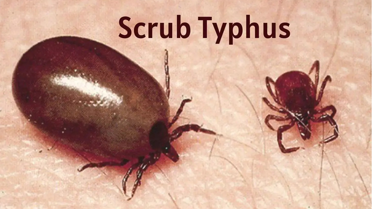 Bajura reports nine cases of scrub typhus in month