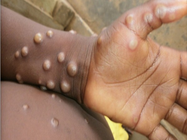 UK health security agency detects 71 new cases of Monkeypox