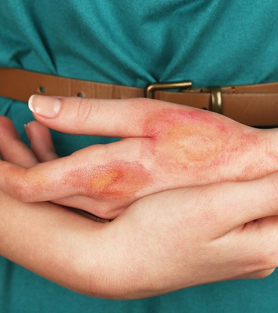 Types of burn injuries: Dr Prativa Shrestha