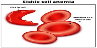 Patients of sickle cell anaemia on the rise in Banke