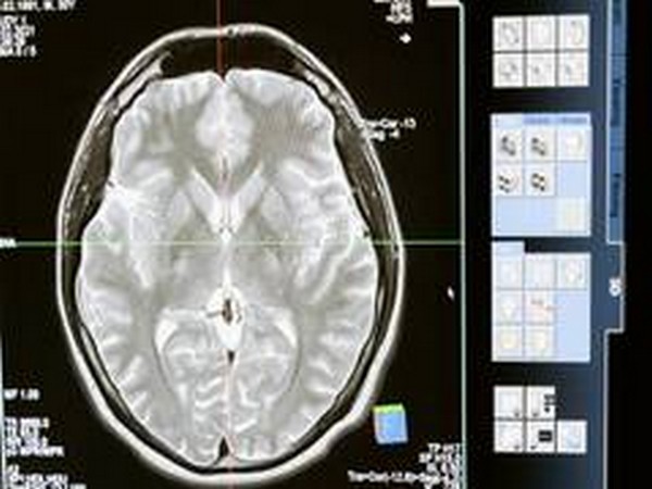 Brain reactions to stress linked with PTSD risk?