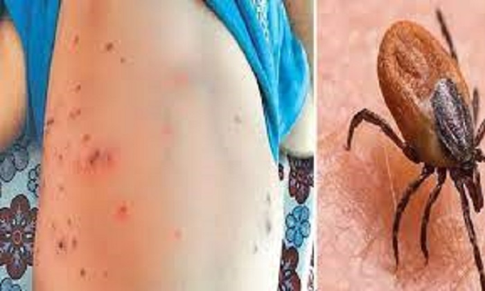 Sudurpaschim: 1,152 Scrub Typhus Cases in 2 Months