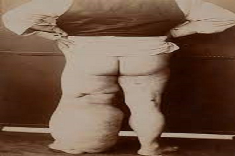 Elephantiasis ‘Medication Card’ is mandatory