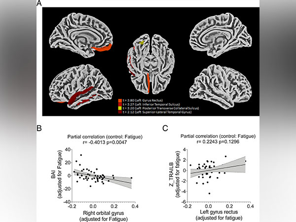 Study describes how COVID-19 damages the brain