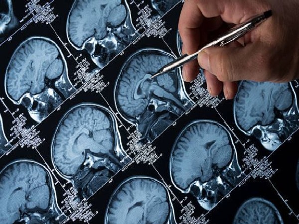 Study: Genetic risk scores can aid accurate diagnosis of epilepsy