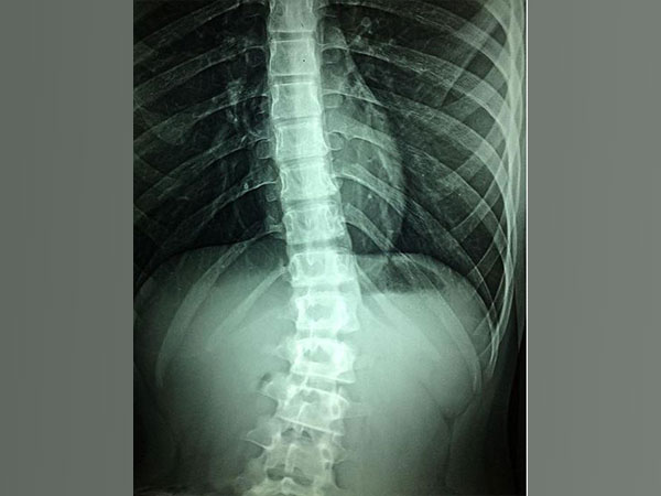 Spinal fractures in elderly avoidable with simple X-ray method