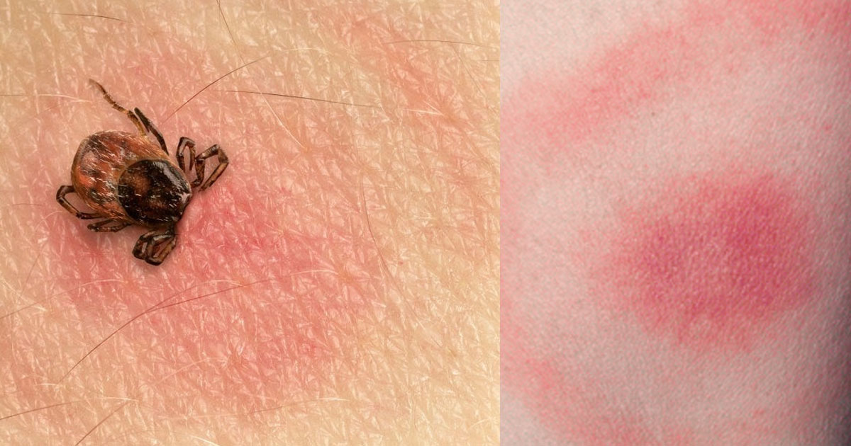 Understanding the Early Signs of Lyme Disease