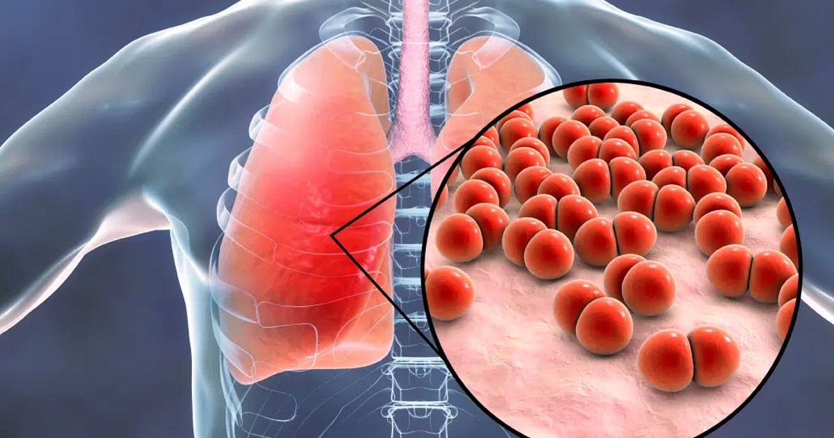 Pneumonia: symptoms, causes and prevention tips you must know