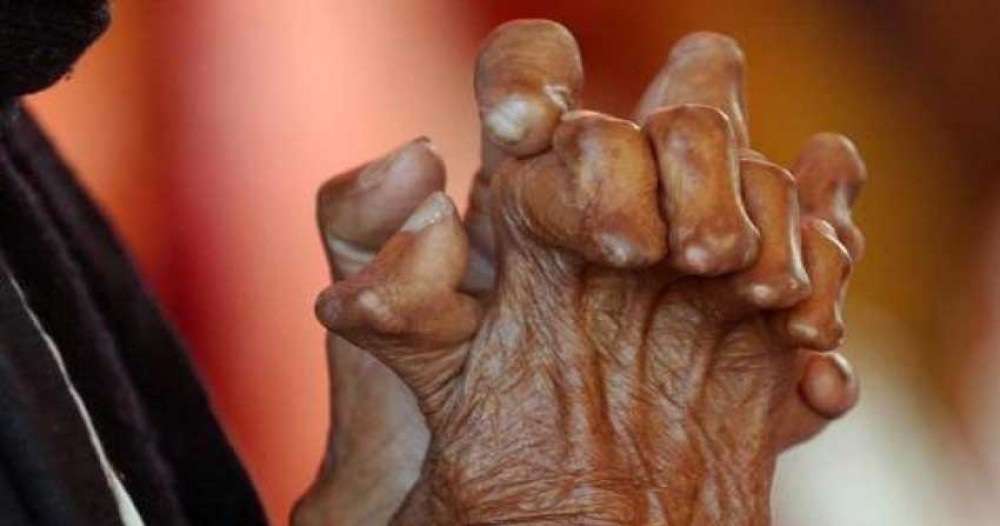 ‘सन् २०३० भित्र कुष्ठरोग नियन्त्रणको लक्ष्य प्राप्ति हुनेछ’